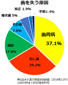 歯を失う原因を示すグラフ第2回永久歯の抜歯原因調査によると歯を失う原因は歯周病が37.1％むし歯は29.2％であった